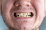 Nicotine stains, Nicotine stains research, are nicotine stains on your teeth irreversible, Oral hygiene