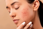 skin care, dermatologist, 10 ways to get rid of pimples at home, Skin care