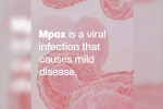 Mpox, mpox in Congo, mpox emergency again, Kenya